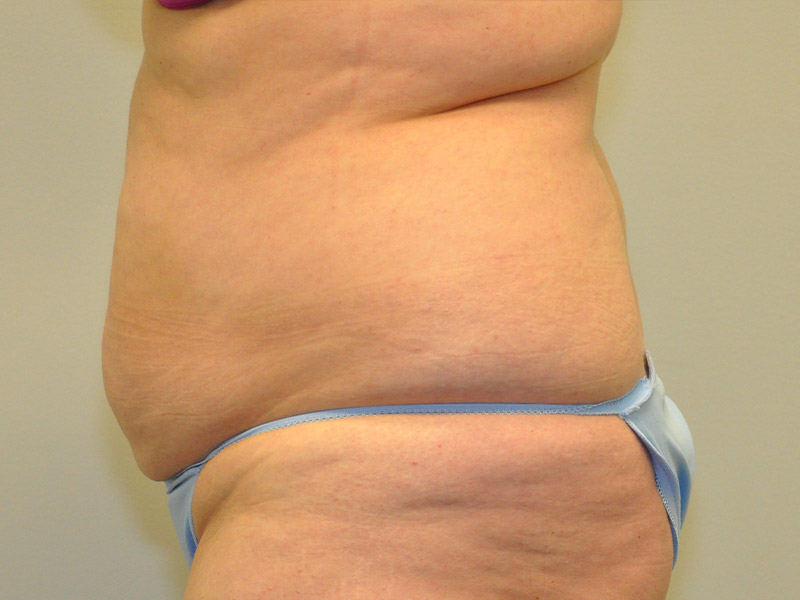 Mommy Makeover Before and After | Steven Ringler MD - Center for Aesthetics And Plastic Surgery