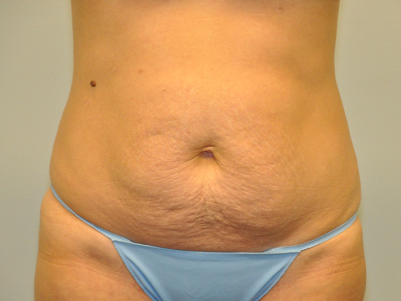 Mommy Makeover Before and After | Steven Ringler MD - Center for Aesthetics And Plastic Surgery