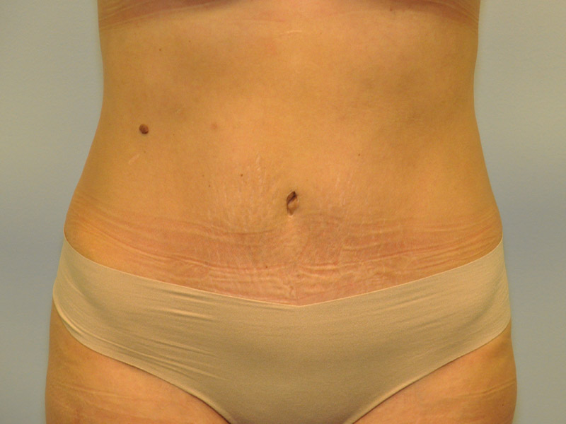 Mommy Makeover Before and After | Steven Ringler MD - Center for Aesthetics And Plastic Surgery