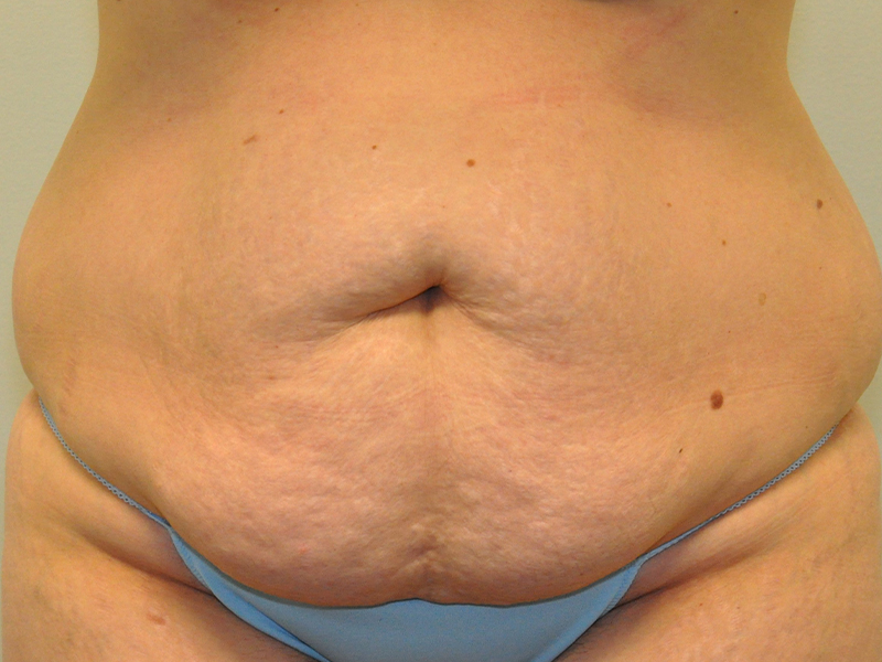 Tummy Tuck Before and After | Steven Ringler MD - Center for Aesthetics And Plastic Surgery