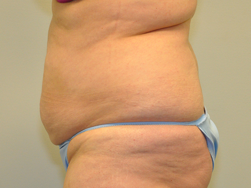 Tummy Tuck Before and After | Steven Ringler MD - Center for Aesthetics And Plastic Surgery