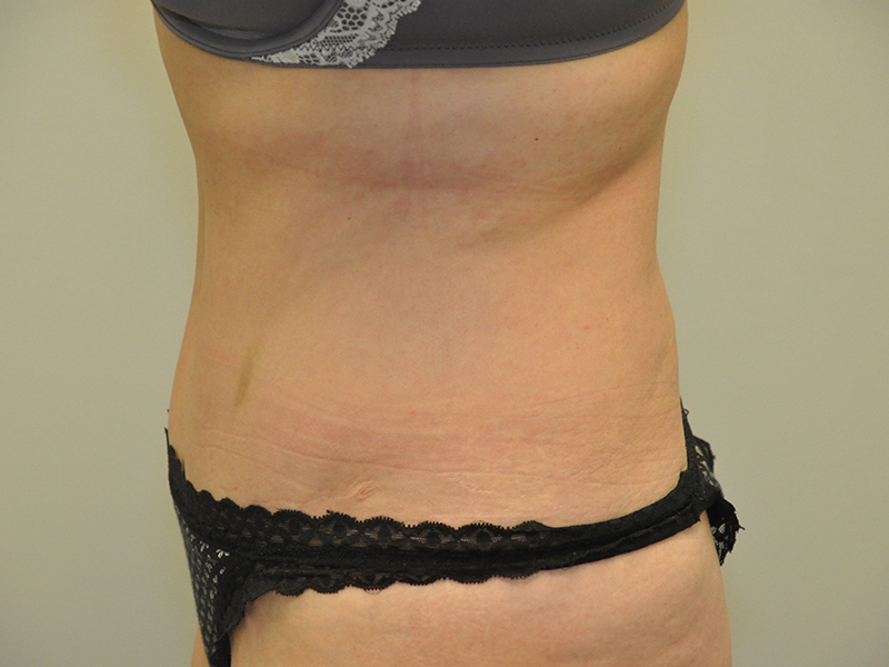 Tummy Tuck Before and After | Steven Ringler MD - Center for Aesthetics And Plastic Surgery