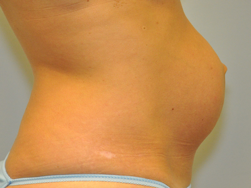Tummy Tuck Before and After | Steven Ringler MD - Center for Aesthetics And Plastic Surgery