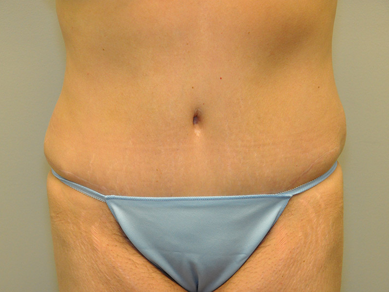 Tummy Tuck Before and After | Steven Ringler MD - Center for Aesthetics And Plastic Surgery
