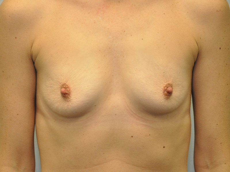 Breast Augmentation Before and After | Steven Ringler MD - Center for Aesthetics And Plastic Surgery