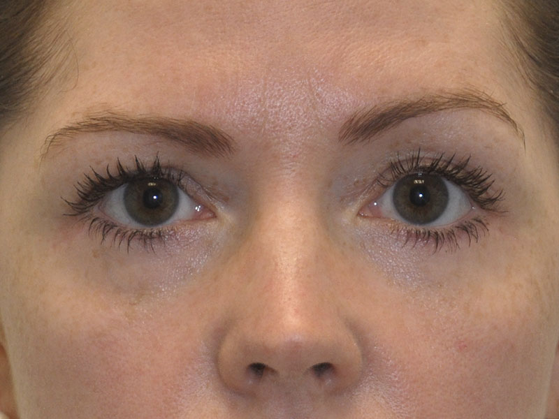 Blepharoplasty Before and After | Steven Ringler MD - Center for Aesthetics And Plastic Surgery