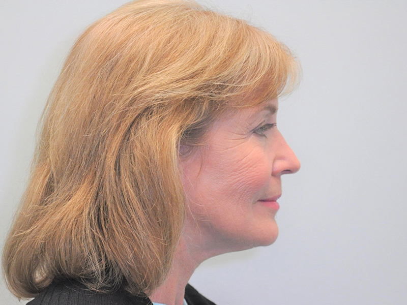 Facelift Before and After | Steven Ringler MD - Center for Aesthetics And Plastic Surgery