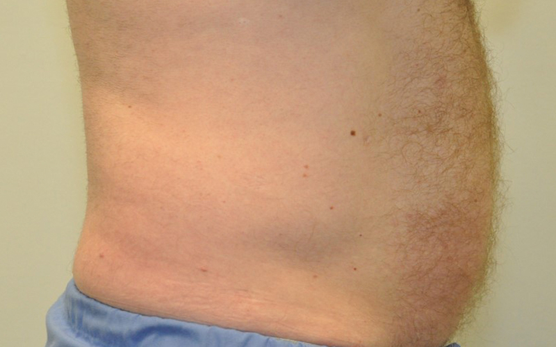 Emsculpt Before and After | Steven Ringler MD - Center for Aesthetics And Plastic Surgery