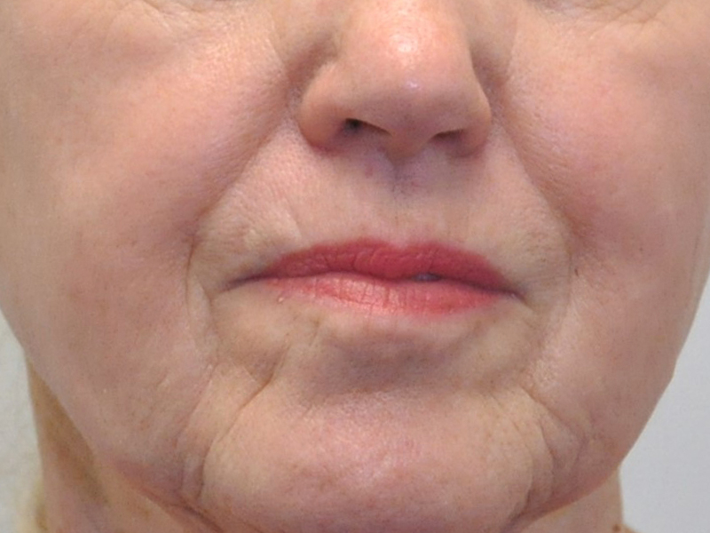 Forever Young Bbl Before and After | Steven Ringler MD - Center for Aesthetics And Plastic Surgery