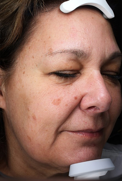 Forever Young Bbl Before and After | Steven Ringler MD - Center for Aesthetics And Plastic Surgery