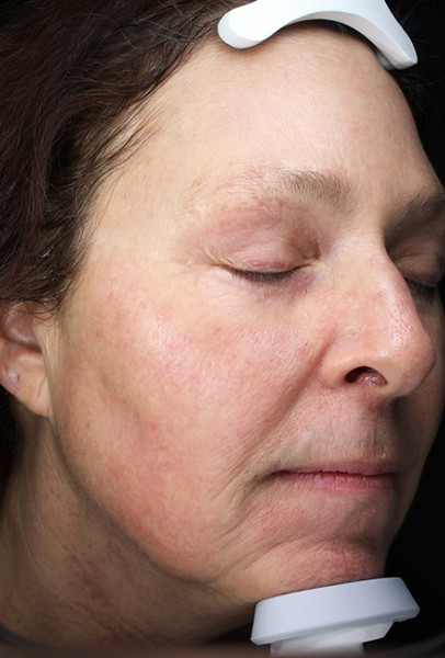 Forever Young Bbl Before and After | Steven Ringler MD - Center for Aesthetics And Plastic Surgery