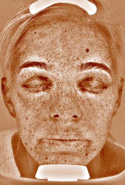Forever Young Bbl Before and After | Steven Ringler MD - Center for Aesthetics And Plastic Surgery