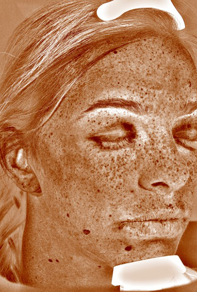 Halo Before and After | Steven Ringler MD - Center for Aesthetics And Plastic Surgery