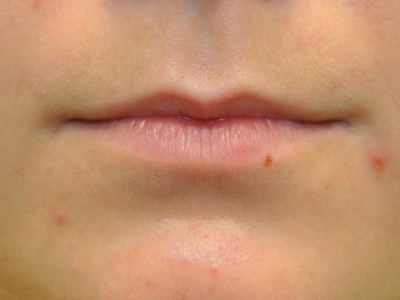 Injectables Before and After | Steven Ringler MD - Center for Aesthetics And Plastic Surgery