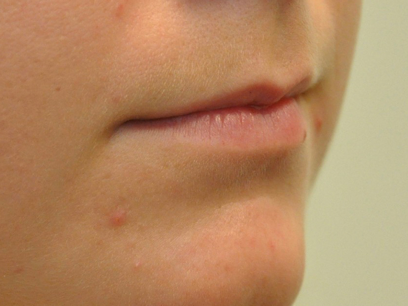 Injectables Before and After | Steven Ringler MD - Center for Aesthetics And Plastic Surgery