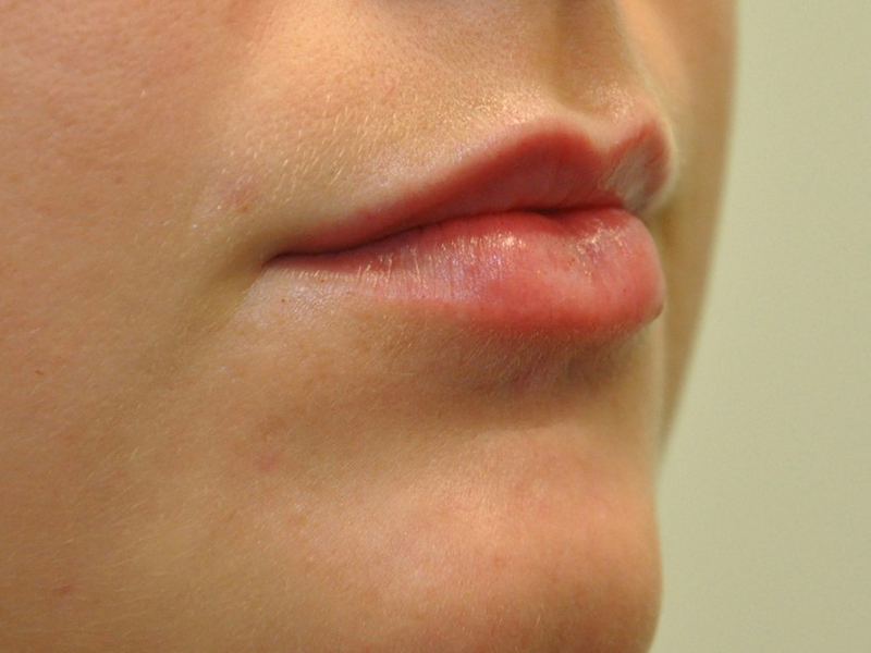 Injectables Before and After | Steven Ringler MD - Center for Aesthetics And Plastic Surgery