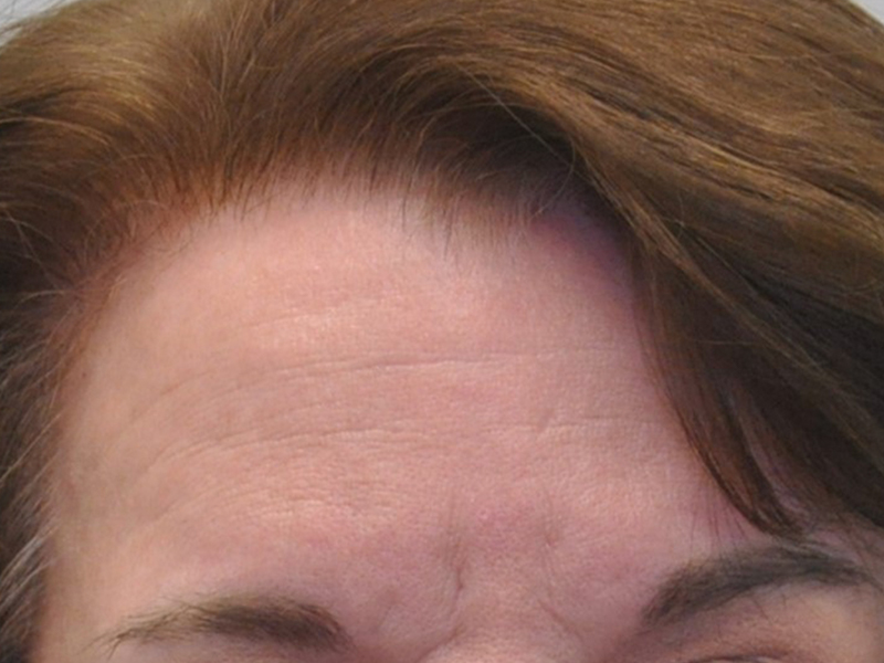 Injectables Before and After | Steven Ringler MD - Center for Aesthetics And Plastic Surgery