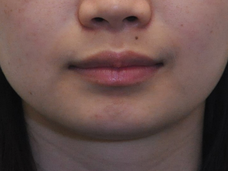 Injectables Before and After | Steven Ringler MD - Center for Aesthetics And Plastic Surgery