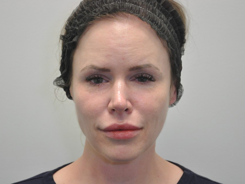Skinpen Before and After | Steven Ringler MD - Center for Aesthetics And Plastic Surgery