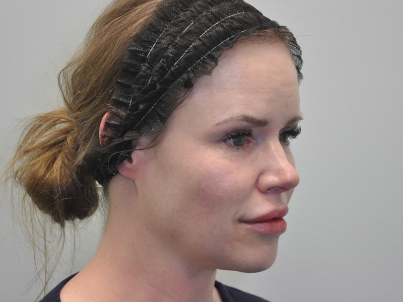 Skinpen Before and After | Steven Ringler MD - Center for Aesthetics And Plastic Surgery