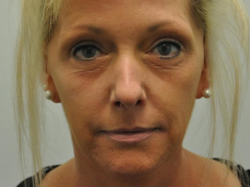 Skinpen Before and After | Steven Ringler MD - Center for Aesthetics And Plastic Surgery