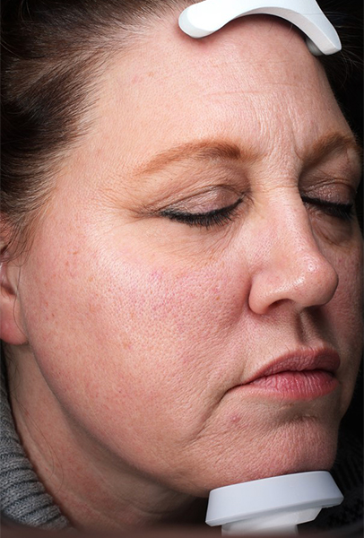 Skinpen Before and After | Steven Ringler MD - Center for Aesthetics And Plastic Surgery